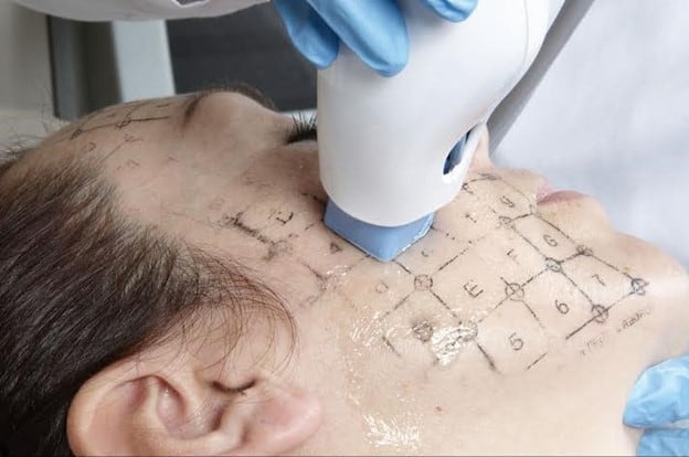 Thermage treatment in singapore - dream aesthetics & plastic surgery