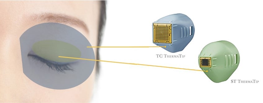 thermage eye treatment