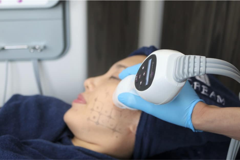 thermage radio frequency lifting treatment