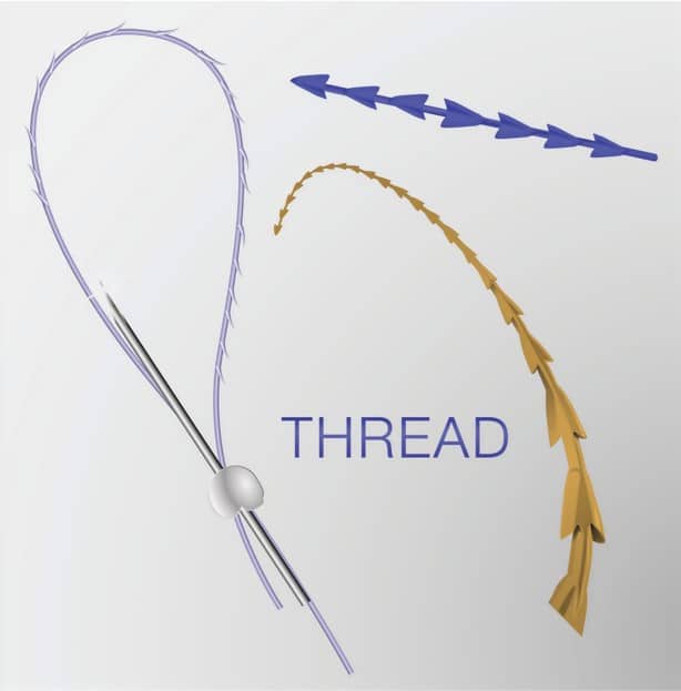 different types of threadlift