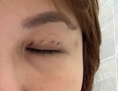 after suture droopy eyelid correction