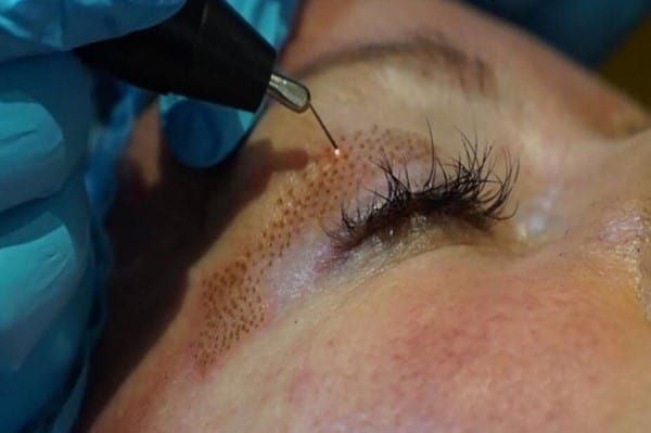 get double eyelids without surgery
