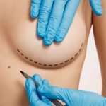 is breast augmentation procedure safe