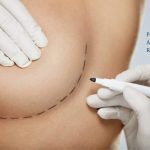 patient's guide to recovery and after care - breast augmentation with implants