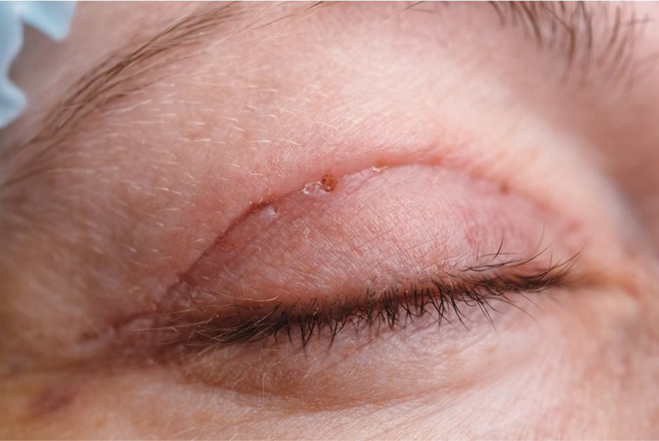 what causes scarring after double eyelid surgery