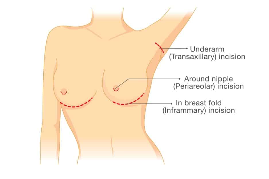 breast incision options