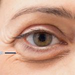 can weight loss cause droopy eyebags