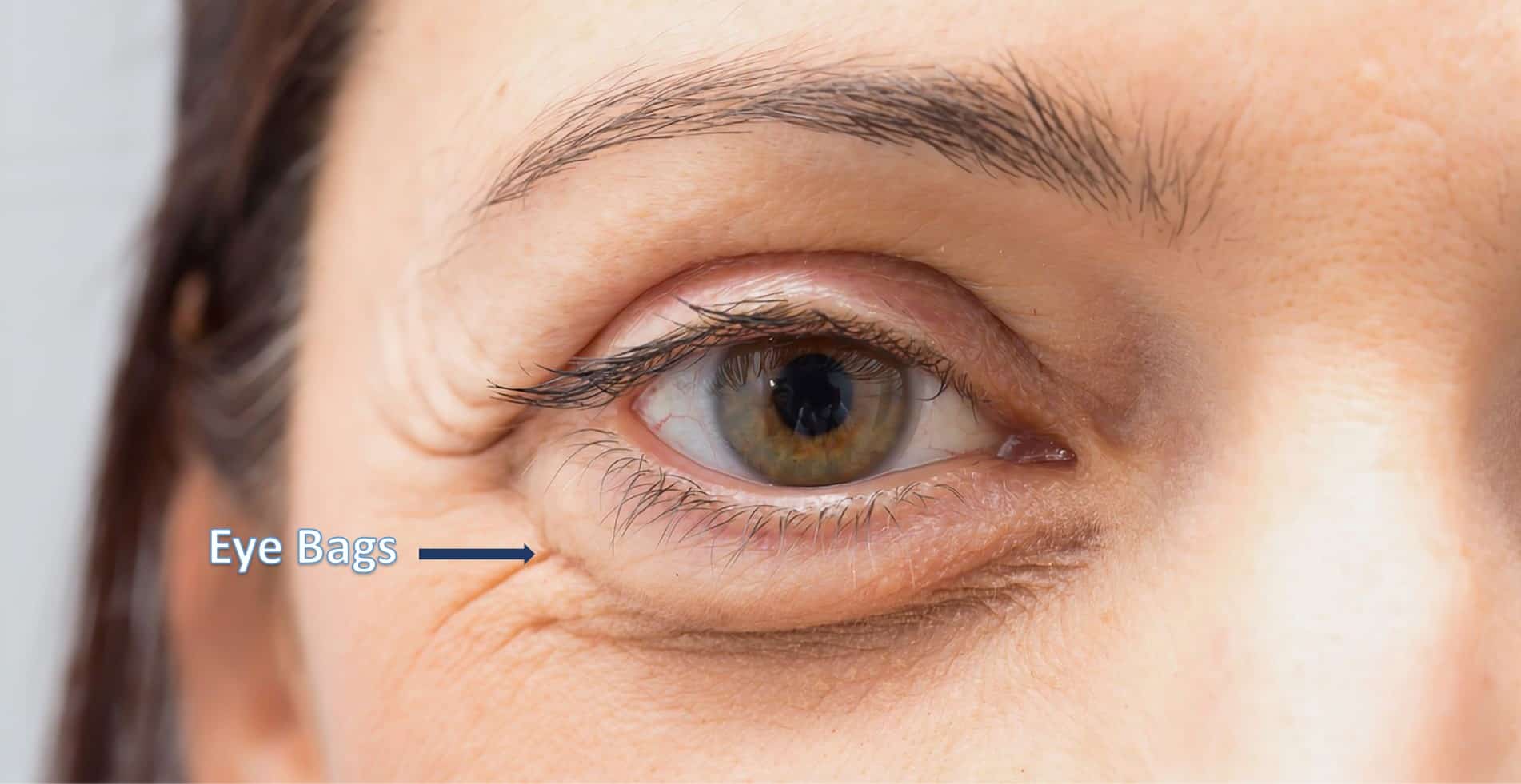 Reason And Treatment For Bags Under Eyes