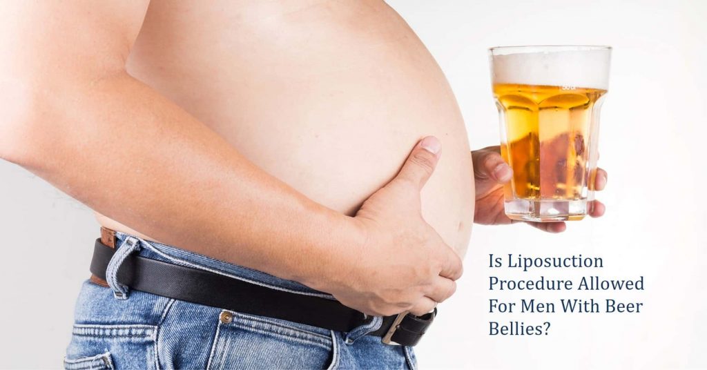 is liposuction allowed for men with beer bellies