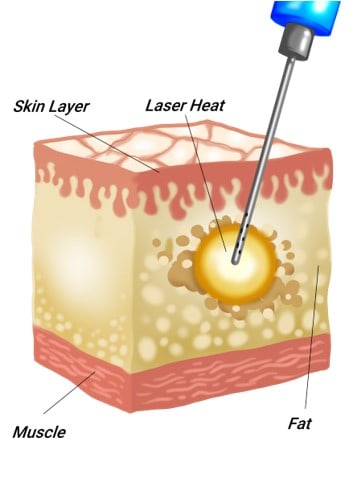 acculsculpt laser lipolysis diagram