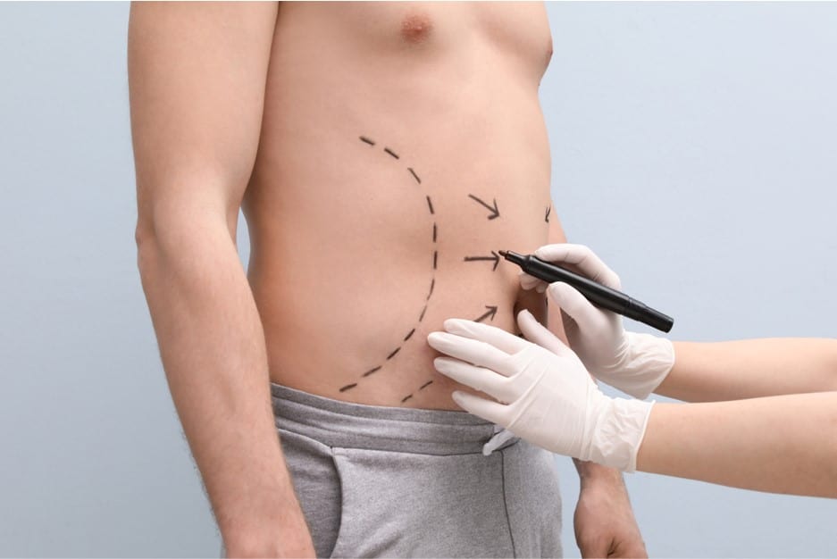 liposuction for men, marking out for liposuction