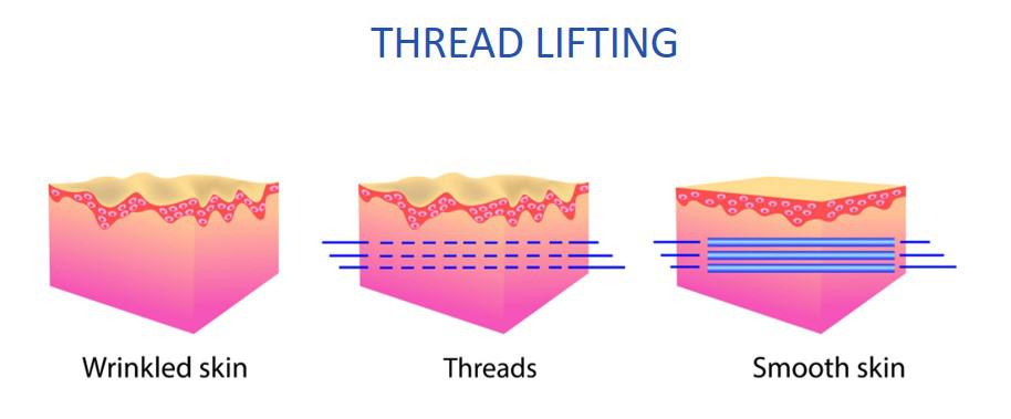 threadlifting on different types of skin diagram