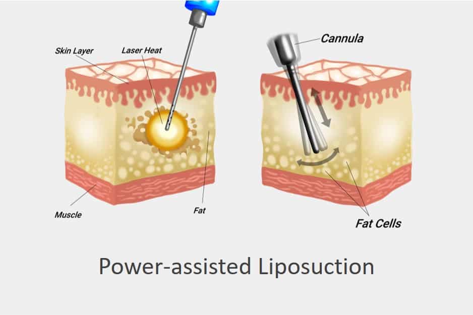 power assisted liposuction