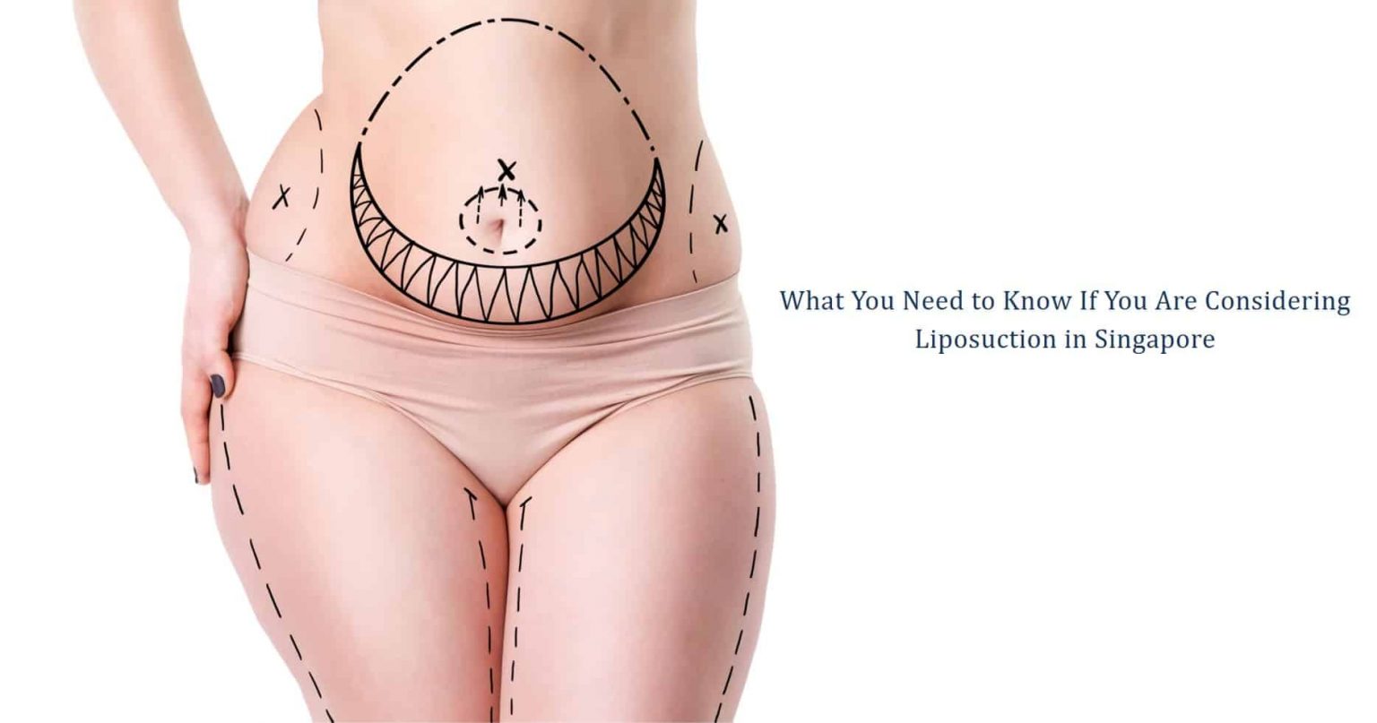 what you need to know if you are considering liposuction