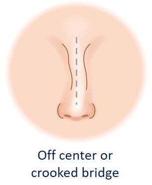 deviated nose