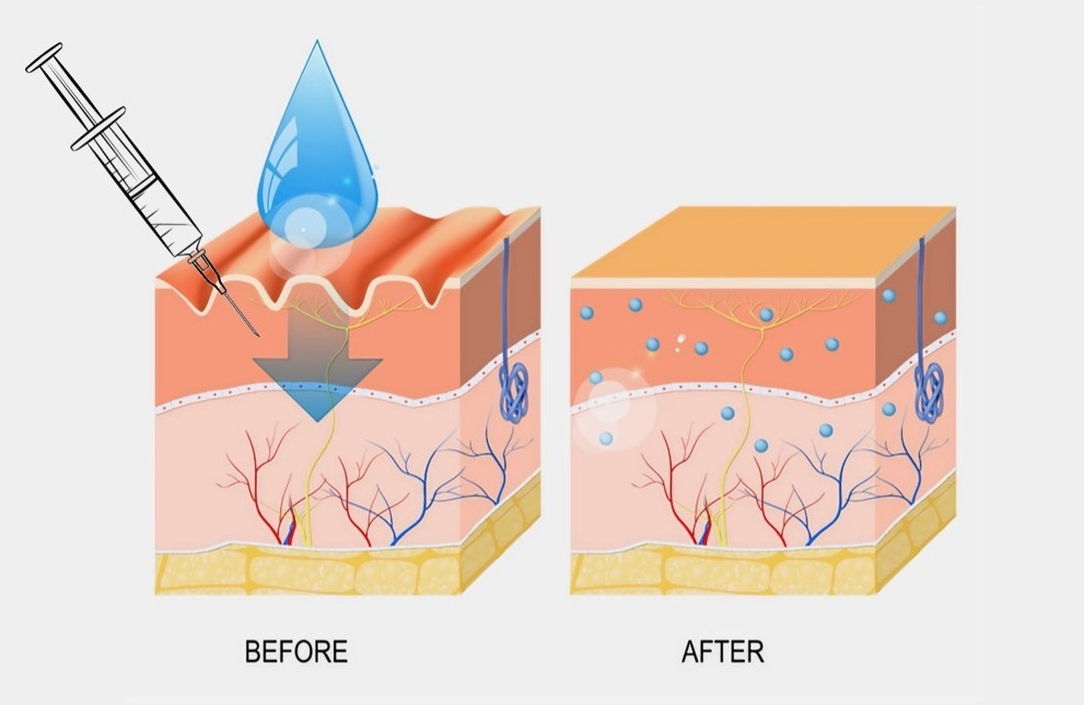 how does skin boosters work