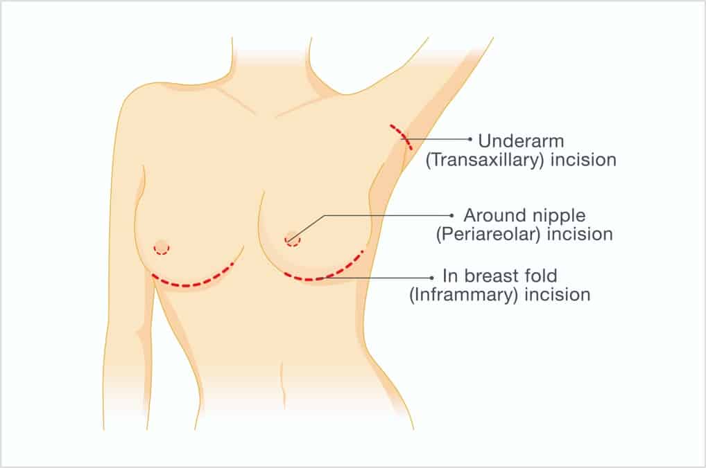 Breast lift (mastopexy) - series—Procedure: MedlinePlus Medical