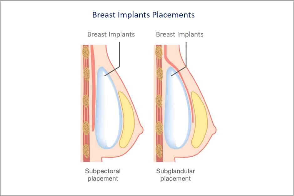 breast implant placements