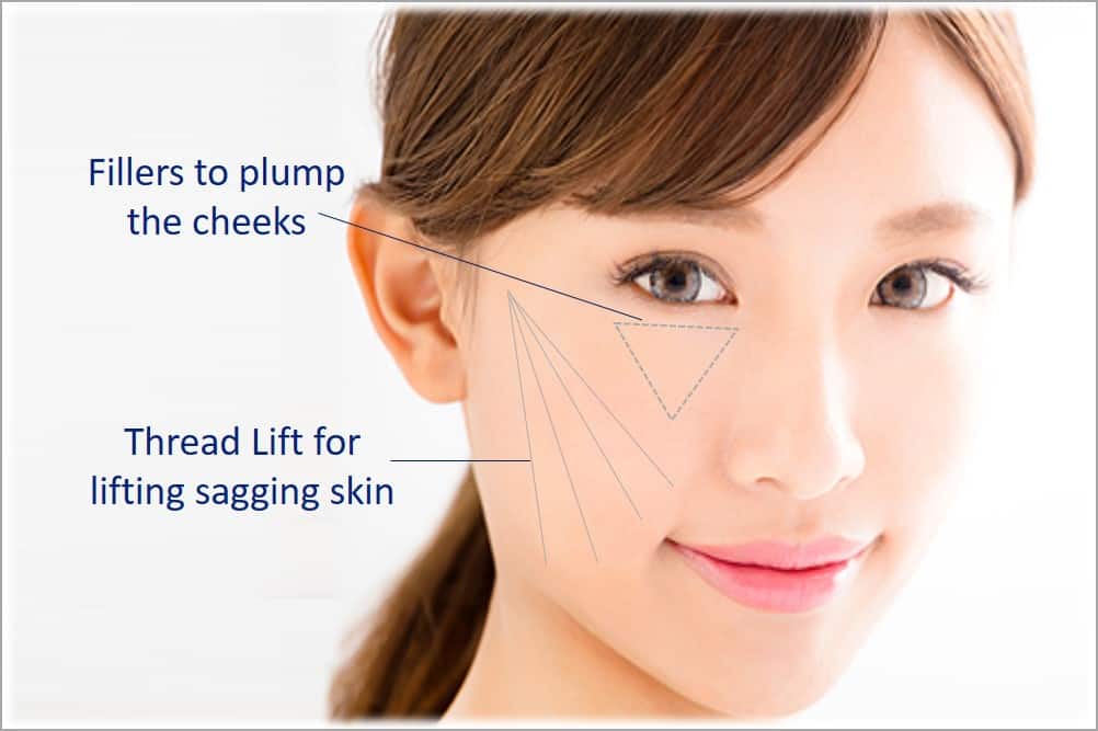 combine fillers and thread lift for lifting