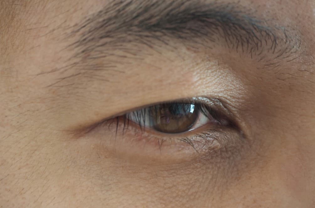 droopy eyelid condition