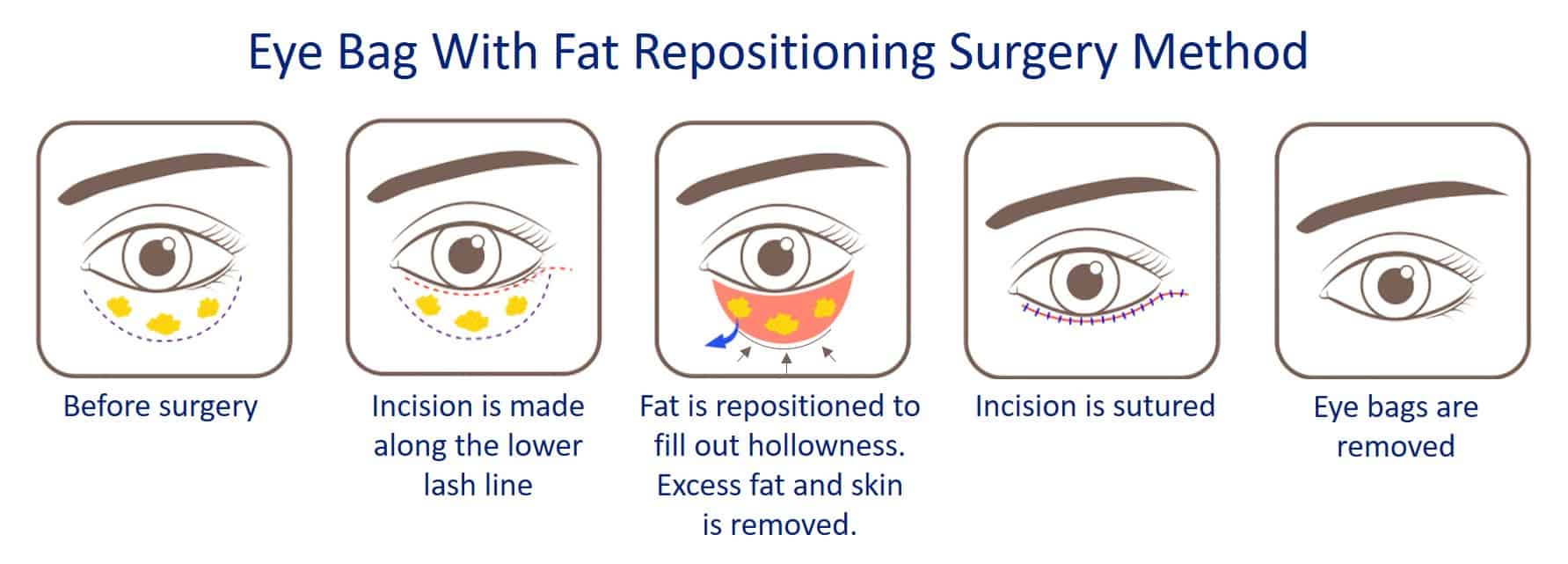 eye bag removal surgery with fat repositioning method