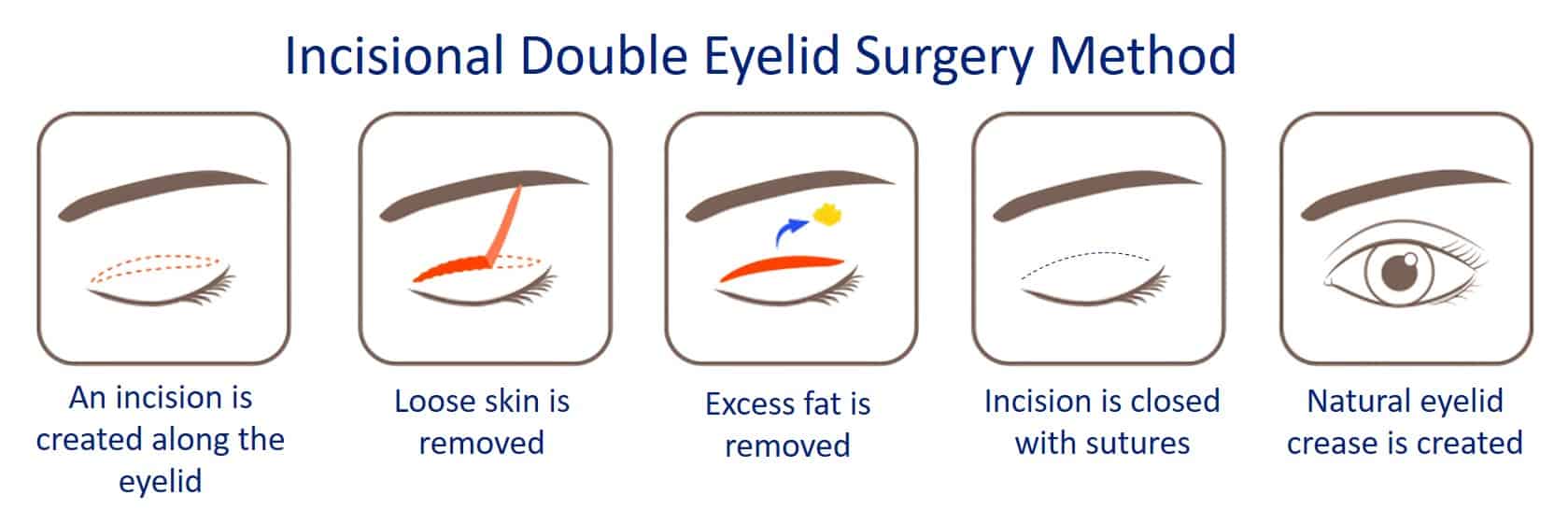 incisional double eyelid surgery method