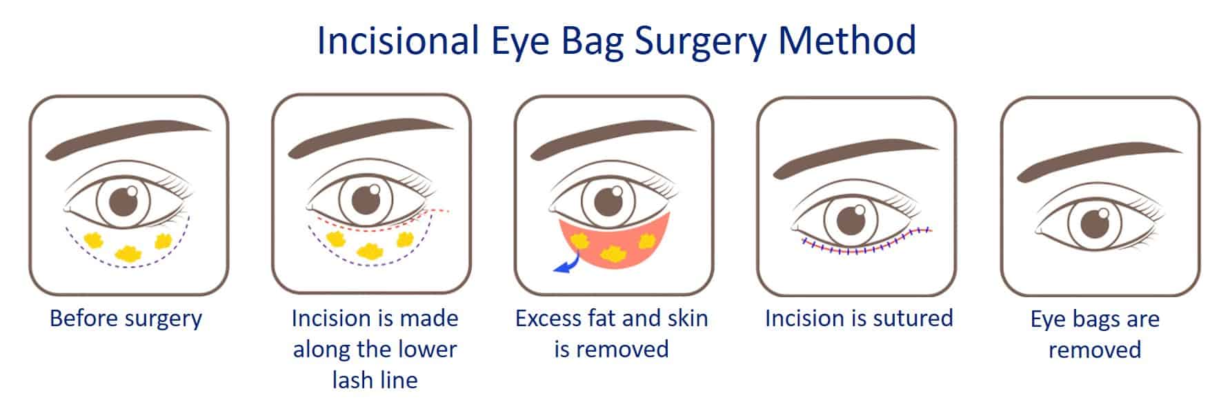 incisional eye bag removal surgery process