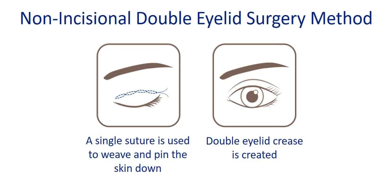 non incisional double eyelid surgery method
