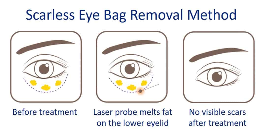 scarless eye bag removal method