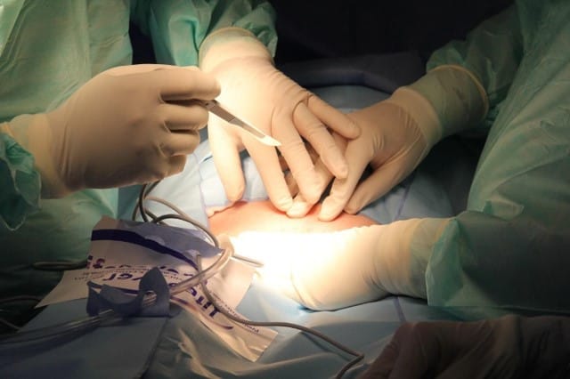 surgeon's skill for fat grafting