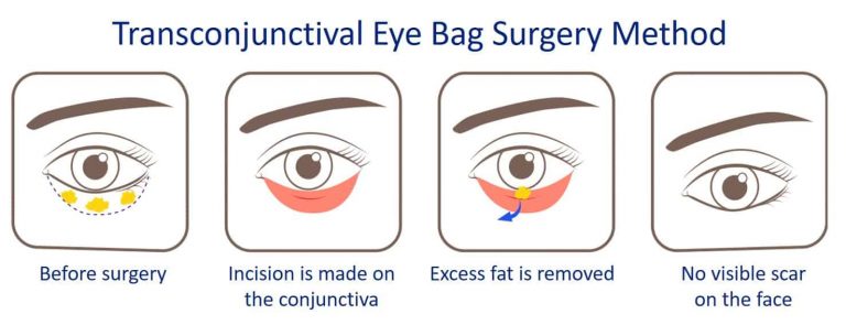 Transconjtival Eye Bag Removal Surgery Method | Dream Plastic Surgery