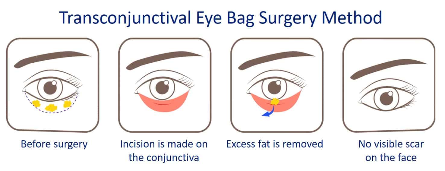 transconjuctival eye bag removal surgery method step by step guide