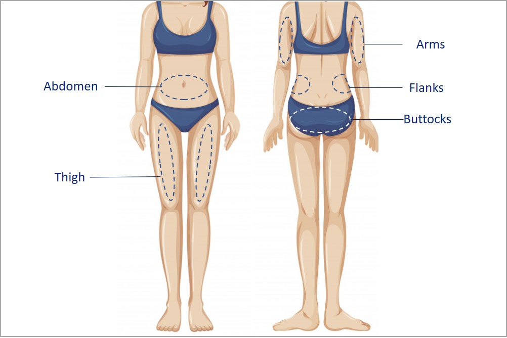 areas for liposuction