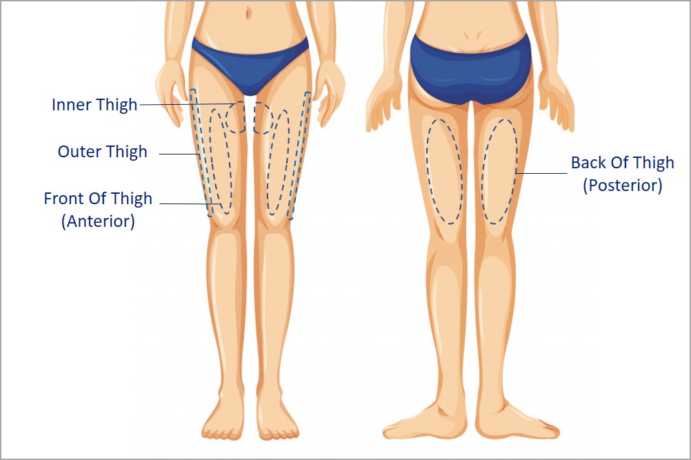 areas suitable for thigh liposuction