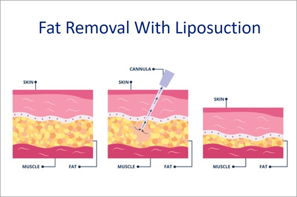 fat removal with liposuction