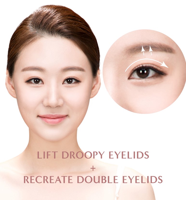 what does incisional double eyelid do