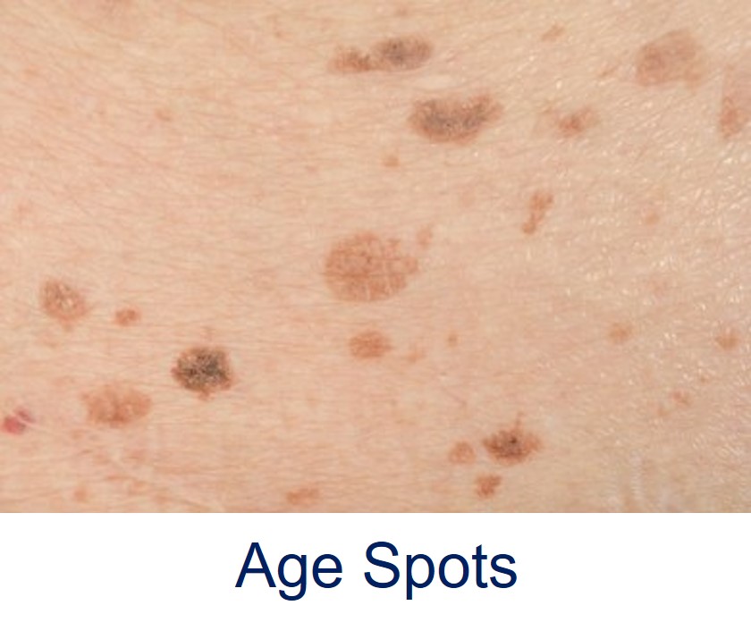 age spots solar lentigo
