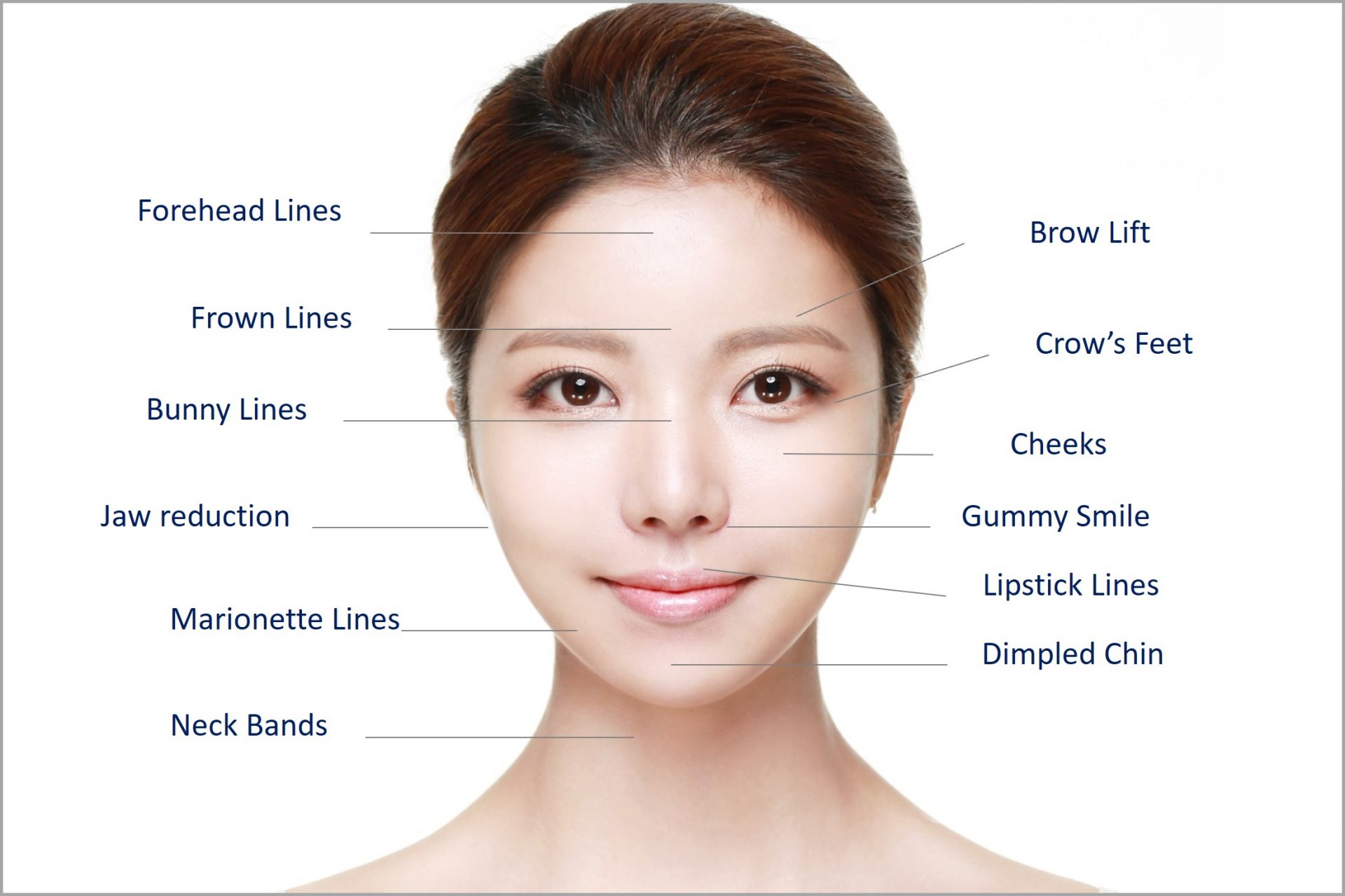 areas suitable for botox