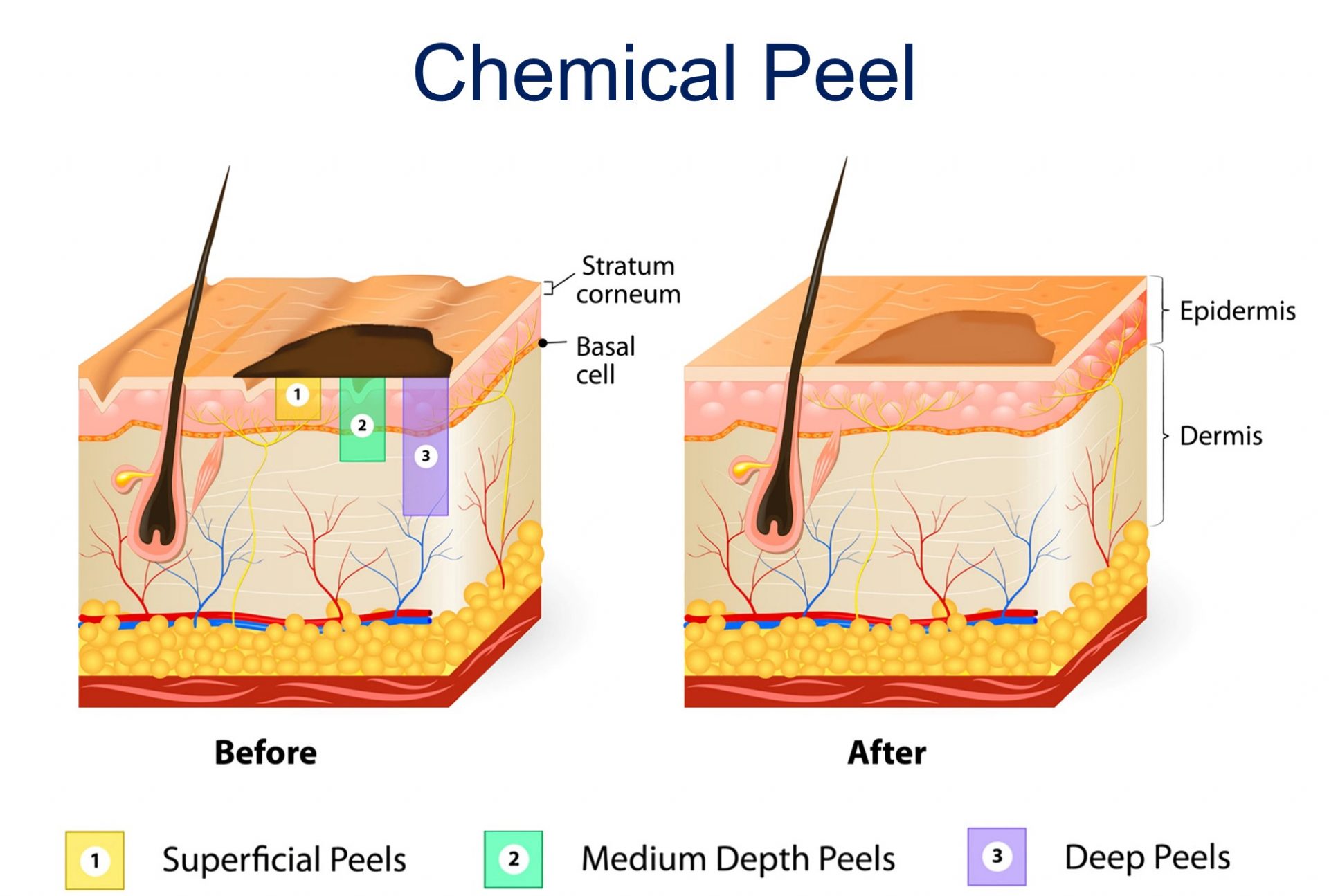 how does chemical peel lighten dark spots and pigmentation