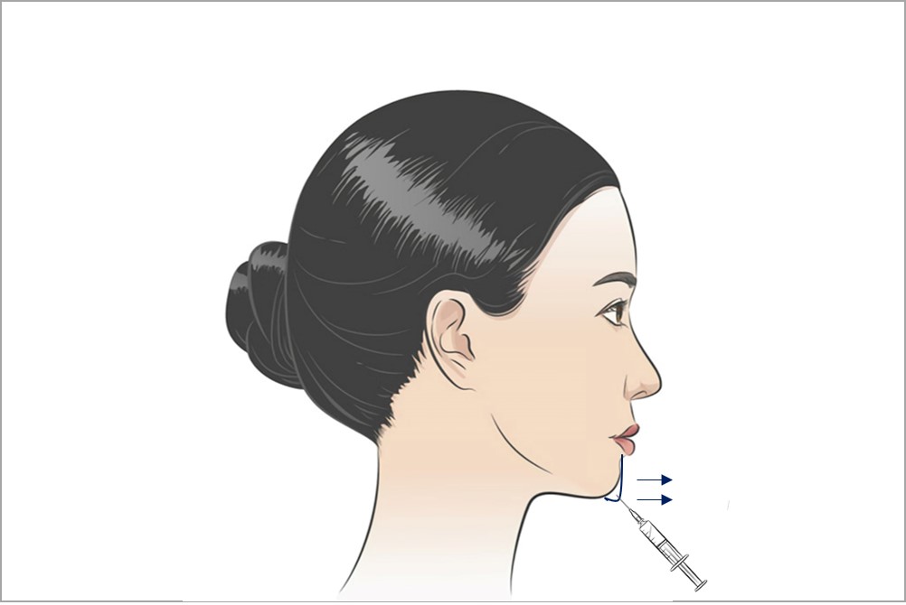 chin fillers for v face