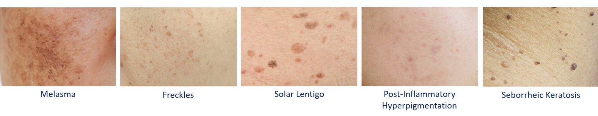 common types of pigmentation in asian skin