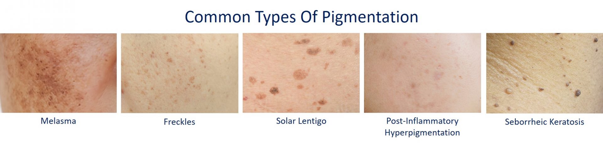 common types of pigmentation in asian skin