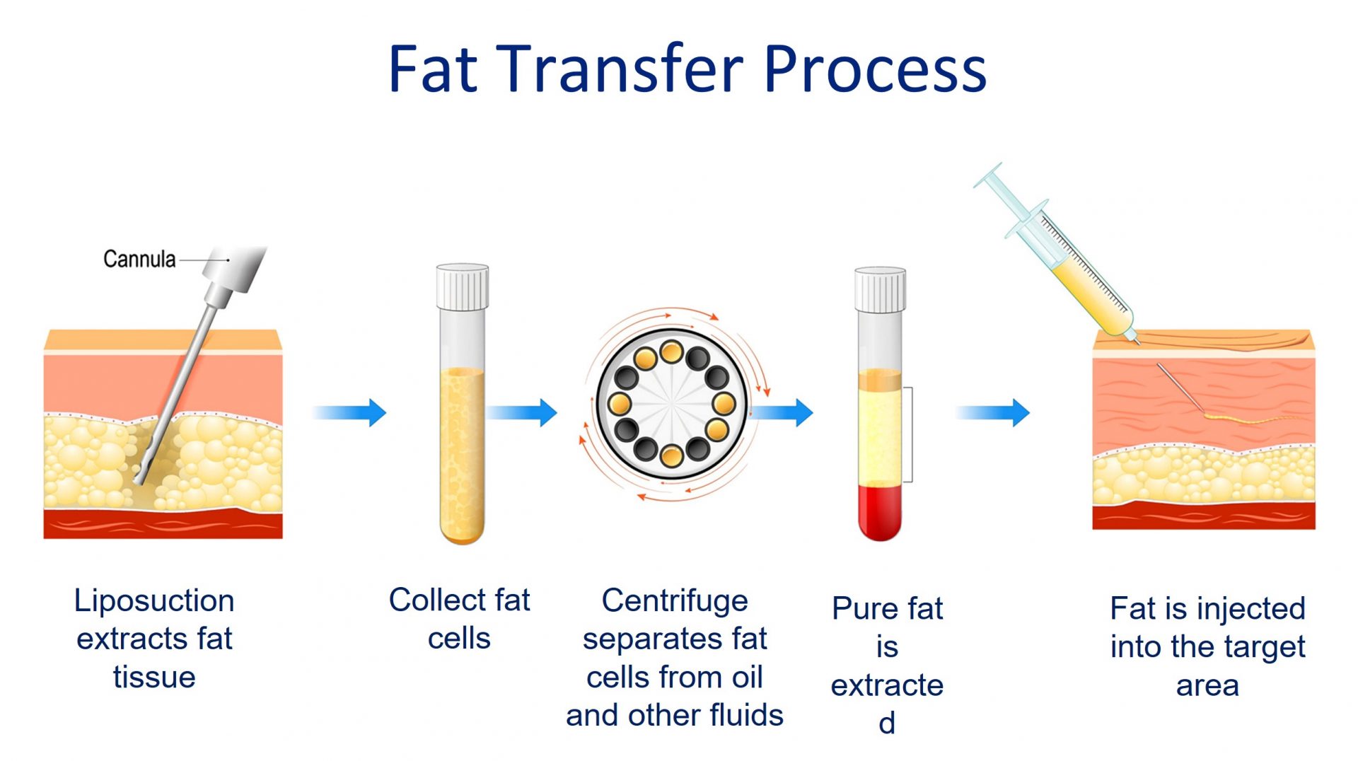 fat transfer process
