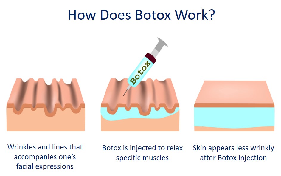 how does botox work