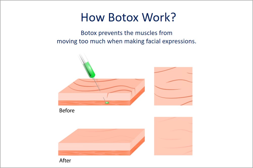 how botox work?