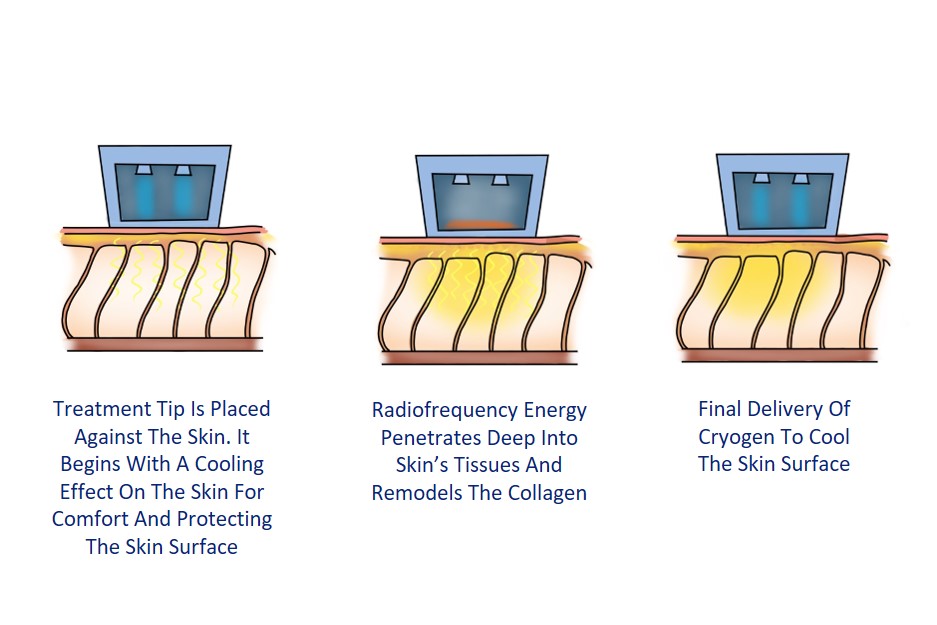 how does thermage work