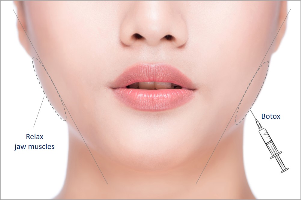 botox jaw slimming and reduction in singapore