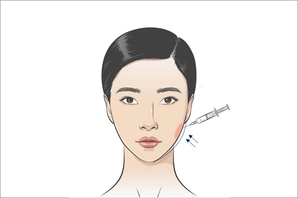 jaw botox slimming for v face