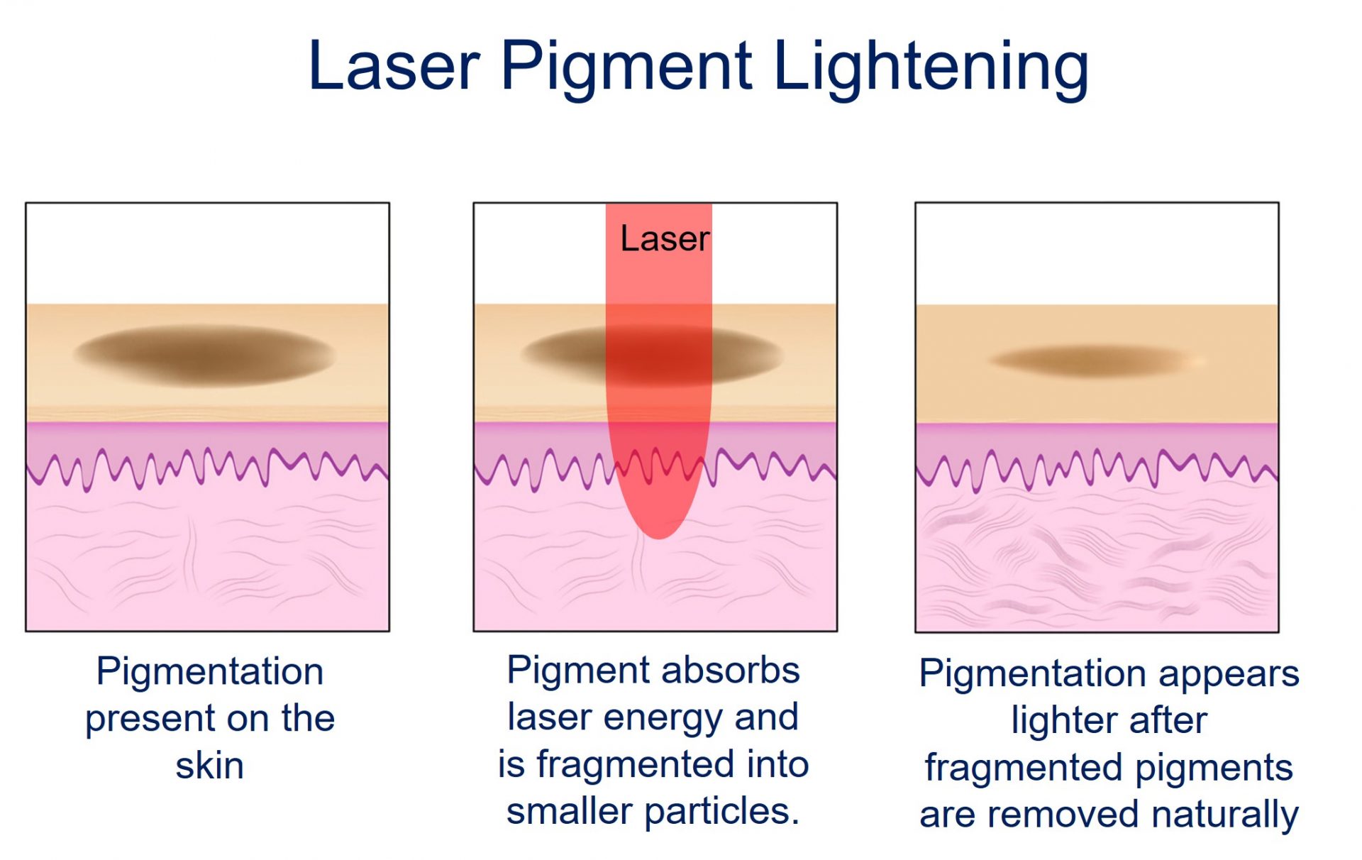 laser pigmentation lightening - how it works