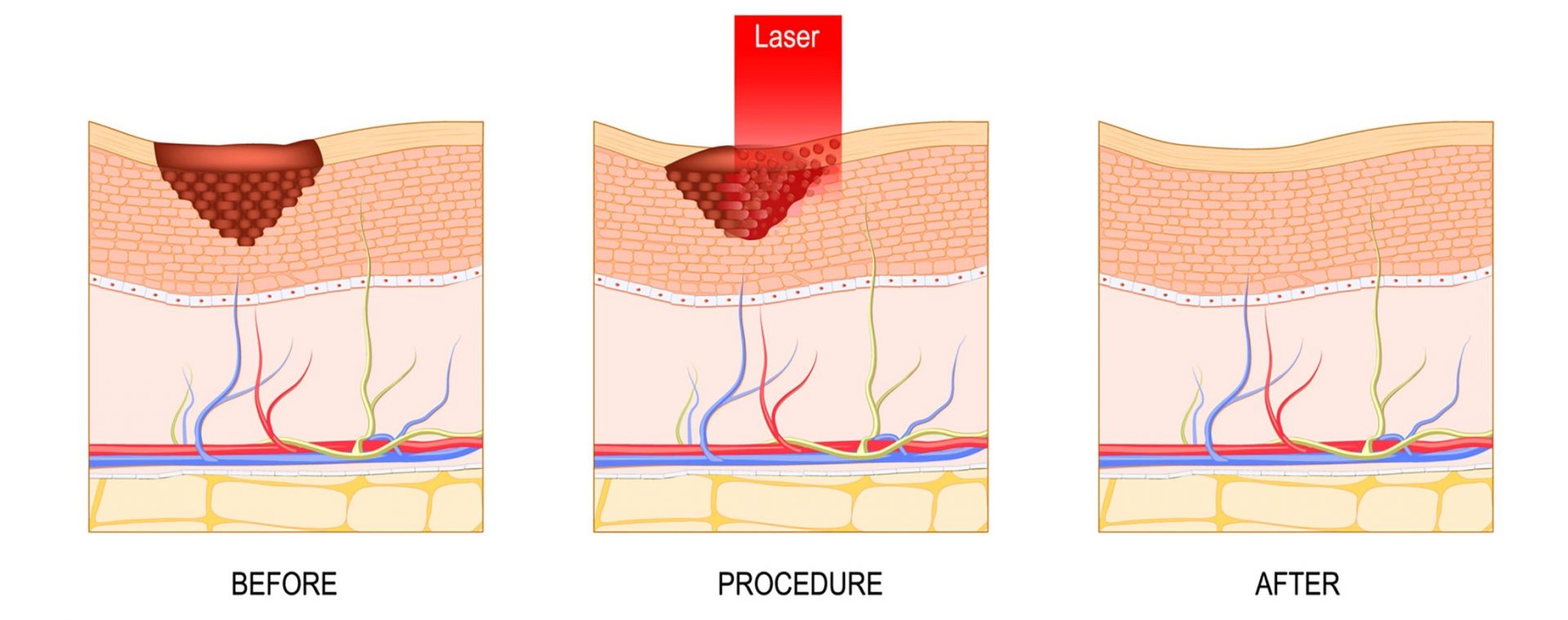 laser for pigmentation and acne scar lightening - how it works